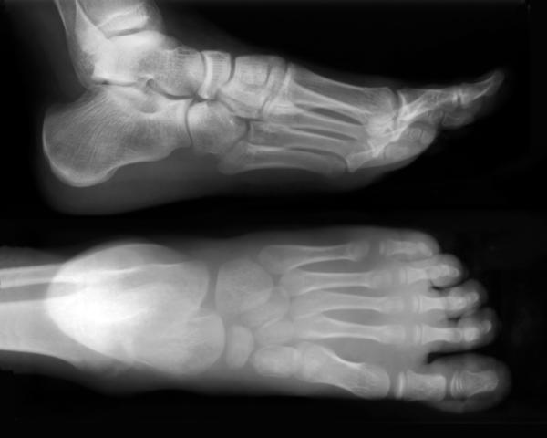 Will Barefoot Running Hurt You?