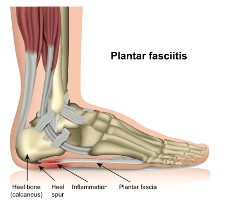 The best shoes deals for planters fasciitis